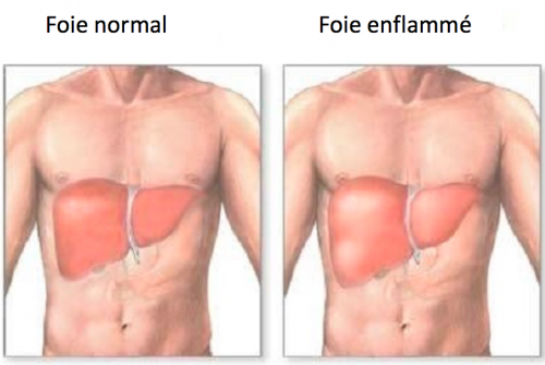 foie-normal-foie-enflammé-500x335